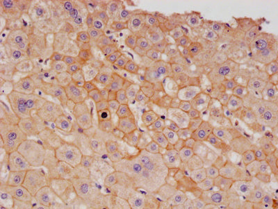 IHC image of ALCAM Recombinant Monoclonal Antibody diluted at 1:100 and staining in paraffin-embedded human liver cancer performed on a Leica BondTM system. After dewaxing and hydration, antigen retrieval was mediated by high pressure in a citrate buffer (pH 6.0). Section was blocked with 10% normal goat serum 30min at RT. Then primary antibody (1% BSA) was incubated at 4°C overnight. The primary is detected by a Goat anti-rabbit polymer IgG labeled by HRP and visualized using 0.05% DAB.ALCAM Recombinant Monoclonal Antibody