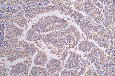 IHC image of DDB2 Recombinant Monoclonal Antibody diluted at 1:50 and staining in paraffin-embedded human cervical cancer performed on a Leica BondTM system. After dewaxing and hydration, antigen retrieval was mediated by high pressure in a citrate buffer (pH 6.0). Section was blocked with 10% normal goat serum 30min at RT. Then primary antibody (1% BSA) was incubated at 4°C overnight. The primary is detected by a Goat anti-rabbit polymer IgG labeled by HRP and visualized using 0.46% DAB.