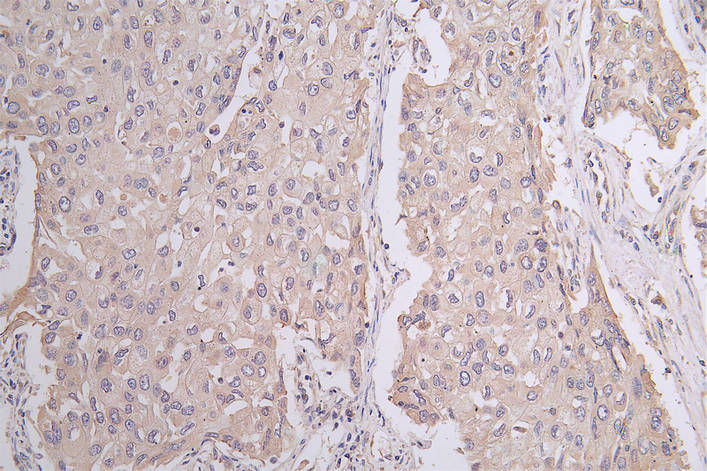 IHC image of PANX1 Recombinant Monoclonal Antibody diluted at 1:50 and staining in paraffin-embedded human lung cancer performed on a Leica BondTM system. After dewaxing and hydration, antigen retrieval was mediated by high pressure in a citrate buffer (pH 6.0). Section was blocked with 10% normal goat serum 30min at RT. Then primary antibody (1% BSA) was incubated at 4°C overnight. The primary is detected by a Goat anti-rabbit polymer IgG labeled by HRP and visualized using 0.1:50% DAB.PANX1 Recombinant Monoclonal Antibody