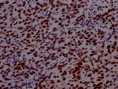 IHC image of PABPN1 Recombinant Monoclonal Antibody diluted at 1:100 and staining in paraffin-embedded human bladder cancer performed on a Leica BondTM system. After dewaxing and hydration, antigen retrieval was mediated by high pressure in a citrate buffer (pH 6.0). Section was blocked with 10% normal goat serum 30min at RT. Then primary antibody (1% BSA) was incubated at 4℃ overnight. The primary is detected by a Goat anti-rabbit IgG polymer labeled by HRP and visualized using 0.05% DAB.