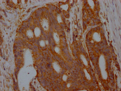IHC image of ALDOA Recombinant Monoclonal Antibody diluted at 1:100 and staining in paraffin-embedded human colon cancer performed on a Leica BondTM system. After dewaxing and hydration, antigen retrieval was mediated by high pressure in a citrate buffer (pH 6.0). Section was blocked with 10% normal goat serum 30min at RT. Then primary antibody (1% BSA) was incubated at 4℃ overnight. The primary is detected by a Goat anti-rabbit IgG polymer labeled by HRP and visualized using 0.05% DAB.ALDOA Recombinant Monoclonal Antibody
