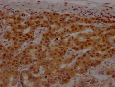 IHC image of PARP1 Recombinant Monoclonal Antibody diluted at 1:100 and staining in paraffin-embedded human breast cancer performed on a Leica BondTM system. After dewaxing and hydration, antigen retrieval was mediated by high pressure in a citrate buffer (pH 6.0). Section was blocked with 10% normal goat serum 30min at RT. Then primary antibody (1% BSA) was incubated at 4℃ overnight. The primary is detected by a Goat anti-rabbit IgG polymer labeled by HRP and visualized using 0.05% DAB.