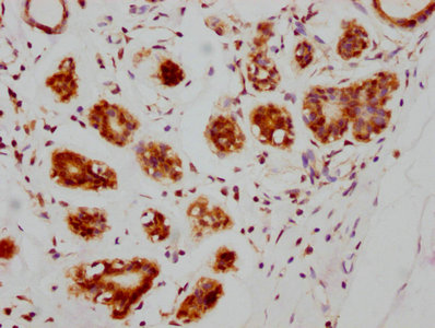 IHC image of ATM Recombinant Monoclonal Antibody diluted at 1:205 and staining in paraffin-embedded human breast cancer performed on a Leica BondTM system. After dewaxing and hydration, antigen retrieval was mediated by high pressure in a citrate buffer (pH 6.0). Section was blocked with 10% normal goat serum 30min at RT. Then primary antibody (1% BSA) was incubated at 4℃ overnight. The primary is detected by a biotinylated secondary antibody and visualized using an HRP conjugated SP system.ATM Recombinant Monoclonal Antibody