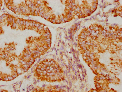 IHC image of BAK1 Recombinant Monoclonal Antibody diluted at 1:90 and staining in paraffin-embedded human endometrial cancer performed on a Leica BondTM system. After dewaxing and hydration, antigen retrieval was mediated by high pressure in a citrate buffer (pH 6.0). Section was blocked with 10% normal goat serum 30min at RT. Then primary antibody (1% BSA) was incubated at 4℃ overnight. The primary is detected by a biotinylated secondary antibody and visualized using an HRP conjugated SP system.BAK1 Recombinant Monoclonal Antibody