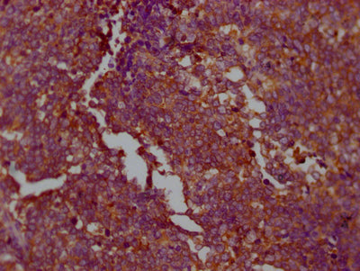 IHC image of PKM Recombinant Monoclonal Antibody diluted at 1:100 and staining in paraffin-embedded human lung cancer performed on a Leica BondTM system. After dewaxing and hydration, antigen retrieval was mediated by high pressure in a citrate buffer (pH 6.0). Section was blocked with 10% normal goat serum 30min at RT. Then primary antibody (1% BSA) was incubated at 4℃ overnight. The primary is detected by a Goat anti-rabbit IgG polymer labeled by HRP and visualized using 0.05% DAB.PKM Recombinant Monoclonal Antibody