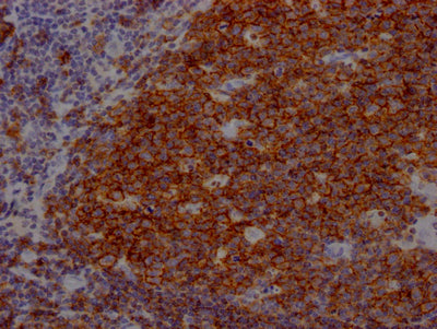 IHC image of CD19 Recombinant Monoclonal Antibody diluted at 1:100 and staining in paraffin-embedded human tonsil tissue performed on a Leica BondTM system. After dewaxing and hydration, antigen retrieval was mediated by high pressure in a citrate buffer (pH 6.0). Section was blocked with 10% normal goat serum 30min at RT. Then primary antibody (1% BSA) was incubated at 4℃ overnight. The primary is detected by a Goat anti-rabbit IgG polymer labeled by HRP and visualized using 0.05% DAB.CD19 Recombinant Monoclonal Antibody