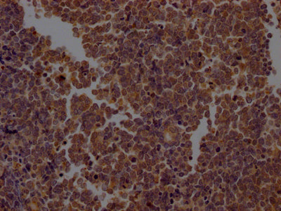 IHC image of CASP2 Recombinant Monoclonal Antibody diluted at 1:100 and staining in paraffin-embedded human lung cancer performed on a Leica BondTM system. After dewaxing and hydration, antigen retrieval was mediated by high pressure in a citrate buffer (pH 6.0). Section was blocked with 10% normal goat serum 30min at RT. Then primary antibody (1% BSA) was incubated at 4℃ overnight. The primary is detected by a Goat anti-rabbit IgG polymer labeled by HRP and visualized using 0.05% DAB.