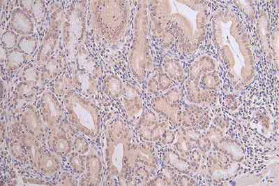 IHC image of the antibody diluted at 1:100 and staining in paraffin-embedded human gastric cancer performed on a Leica BondTM system. After dewaxing and hydration, antigen retrieval was mediated by high pressure in a citrate buffer (pH 6.0). Section was blocked with 10% normal goat serum 30min at RT. Then primary antibody (1% BSA) was incubated at 4°C overnight. The primary is detected by a Goat anti-rabbit polymer IgG labeled by HRP and visualized using 0.06% DAB.Mono-methyl-HIST1H3A (K9) Recombinant Monoclonal Antibody