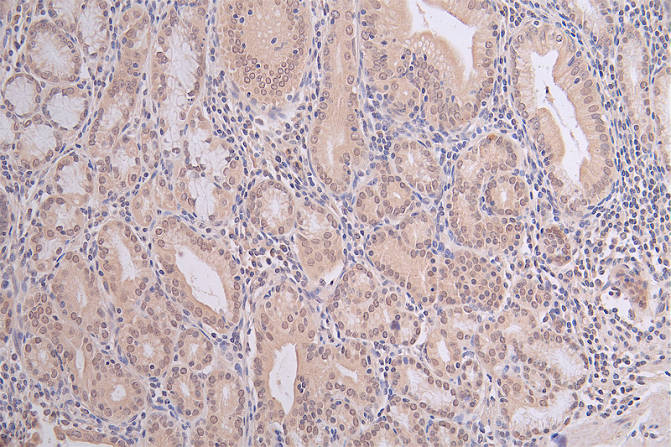 IHC image of the antibody diluted at 1:100 and staining in paraffin-embedded human gastric cancer performed on a Leica BondTM system. After dewaxing and hydration, antigen retrieval was mediated by high pressure in a citrate buffer (pH 6.0). Section was blocked with 10% normal goat serum 30min at RT. Then primary antibody (1% BSA) was incubated at 4°C overnight. The primary is detected by a Goat anti-rabbit polymer IgG labeled by HRP and visualized using 0.06% DAB.Mono-methyl-HIST1H3A (K9) Recombinant Monoclonal Antibody