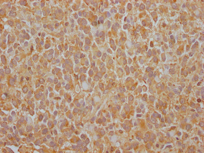 IHC image of EGFR Recombinant Monoclonal Antibody diluted at 1:100 and staining in paraffin-embedded human glioma cancer performed on a Leica BondTM system. After dewaxing and hydration, antigen retrieval was mediated by high pressure in a citrate buffer (pH 6.0). Section was blocked with 10% normal goat serum 30min at RT. Then primary antibody (1% BSA) was incubated at 4℃ overnight. The primary is detected by a Goat anti-rabbit IgG polymer labeled by HRP and visualized using 0.05% DAB.