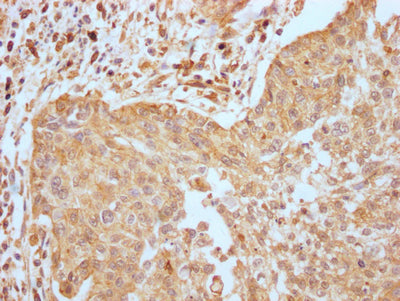 IHC image of EGFR Recombinant Monoclonal Antibody diluted at 1:100 and staining in paraffin-embedded human cervical cancer performed on a Leica BondTM system. After dewaxing and hydration, antigen retrieval was mediated by high pressure in a citrate buffer (pH 6.0). Section was blocked with 10% normal goat serum 30min at RT. Then primary antibody (1% BSA) was incubated at 4℃ overnight. The primary is detected by a Goat anti-rabbit IgG polymer labeled by HRP and visualized using 0.05% DAB.