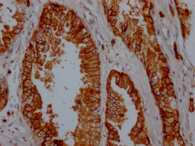 IHC image of CD38 Recombinant Monoclonal Antibody diluted at 1:100 and staining in paraffin-embedded human prostate cancer performed on a Leica BondTM system. After dewaxing and hydration, antigen retrieval was mediated by high pressure in a citrate buffer (pH 6.0). Section was blocked with 10% normal goat serum 30min at RT. Then primary antibody (1% BSA) was incubated at 4℃ overnight. The primary is detected by a Goat anti-rabbit IgG polymer labeled by HRP and visualized using 0.05% DAB.