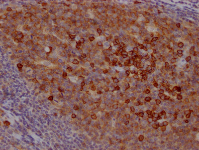 IHC image of CD38 Recombinant Monoclonal Antibody diluted at 1:100 and staining in paraffin-embedded human tonsil tissue performed on a Leica BondTM system. After dewaxing and hydration, antigen retrieval was mediated by high pressure in a citrate buffer (pH 6.0). Section was blocked with 10% normal goat serum 30min at RT. Then primary antibody (1% BSA) was incubated at 4℃ overnight. The primary is detected by a Goat anti-rabbit IgG polymer labeled by HRP and visualized using 0.05% DAB.