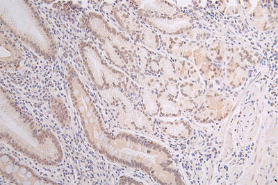 IHC image of the antibody diluted at 1:50 and staining in paraffin-embedded human gastric cancer performed on a Leica BondTM system. After dewaxing and hydration, antigen retrieval was mediated by high pressure in a citrate buffer (pH 6.0). Section was blocked with 10% normal goat serum 30min at RT. Then primary antibody (1% BSA) was incubated at 4°C overnight. The primary is detected by a Goat anti-rabbit polymer IgG labeled by HRP and visualized using 0.67% DAB.