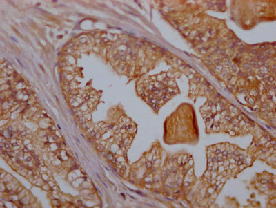 IHC image of CD47 Recombinant Monoclonal Antibody diluted at 1:100 and staining in paraffin-embedded human prostate cancer performed on a Leica BondTM system. After dewaxing and hydration, antigen retrieval was mediated by high pressure in a citrate buffer (pH 6.0). Section was blocked with 10% normal goat serum 30min at RT. Then primary antibody (1% BSA) was incubated at 4℃ overnight. The primary is detected by a Goat anti-rabbit IgG polymer labeled by HRP and visualized using 0.05% DAB.CD47 Recombinant Monoclonal Antibody