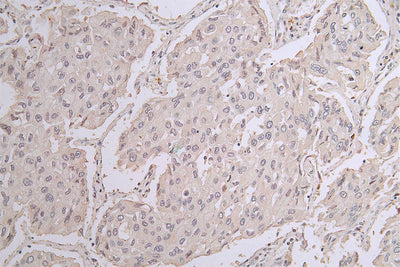 IHC image of CHAT Recombinant Monoclonal Antibody diluted at 1:50 and staining in paraffin-embedded human lung cancer performed on a Leica BondTM system. After dewaxing and hydration, antigen retrieval was mediated by high pressure in a citrate buffer (pH 6.0). Section was blocked with 10% normal goat serum 30min at RT. Then primary antibody (1% BSA) was incubated at 4°C overnight. The primary is detected by a Goat anti-rabbit polymer IgG labeled by HRP and visualized using 0.22% DAB.