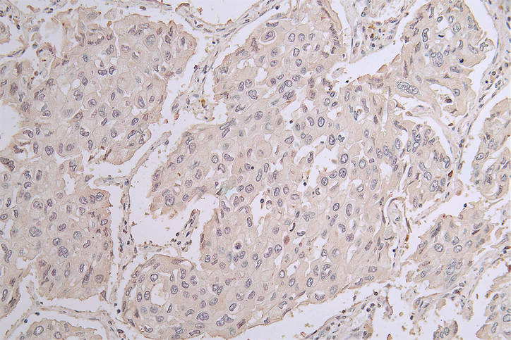 IHC image of CHAT Recombinant Monoclonal Antibody diluted at 1:50 and staining in paraffin-embedded human lung cancer performed on a Leica BondTM system. After dewaxing and hydration, antigen retrieval was mediated by high pressure in a citrate buffer (pH 6.0). Section was blocked with 10% normal goat serum 30min at RT. Then primary antibody (1% BSA) was incubated at 4°C overnight. The primary is detected by a Goat anti-rabbit polymer IgG labeled by HRP and visualized using 0.22% DAB.