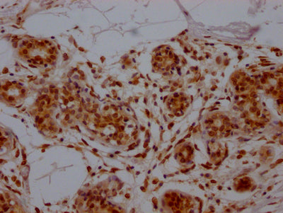 IHC image of E2F1 Recombinant Monoclonal Antibody diluted at 1:100 and staining in paraffin-embedded human breast cancer performed on a Leica BondTM system. After dewaxing and hydration, antigen retrieval was mediated by high pressure in a citrate buffer (pH 6.0). Section was blocked with 10% normal goat serum 30min at RT. Then primary antibody (1% BSA) was incubated at 4℃ overnight. The primary is detected by a Goat anti-rabbit IgG polymer labeled by HRP and visualized using 0.05% DAB.