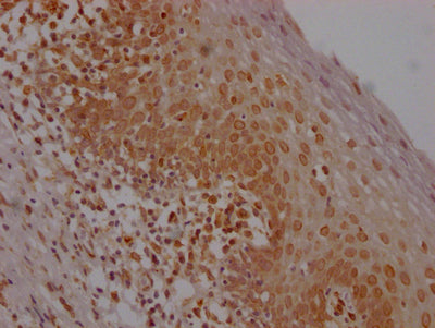 IHC image of E2F1 Recombinant Monoclonal Antibody diluted at 1:100 and staining in paraffin-embedded human tonsil tissue performed on a Leica BondTM system. After dewaxing and hydration, antigen retrieval was mediated by high pressure in a citrate buffer (pH 6.0). Section was blocked with 10% normal goat serum 30min at RT. Then primary antibody (1% BSA) was incubated at 4℃ overnight. The primary is detected by a Goat anti-rabbit IgG polymer labeled by HRP and visualized using 0.05% DAB.
