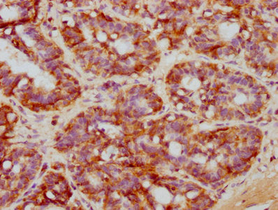 IHC image of NDRG1 Recombinant Monoclonal Antibody diluted at 1:71.6666666666667 and staining in paraffin-embedded human breast cancer performed on a Leica BondTM system. After dewaxing and hydration, antigen retrieval was mediated by high pressure in a citrate buffer (pH 6.0). Section was blocked with 10% normal goat serum 30min at RT. Then primary antibody (1% BSA) was incubated at 4℃ overnight. The primary is detected by a biotinylated secondary antibody and visualized using an HRP conjugated SP system.NDRG1 Recombinant Monoclonal Antibody
