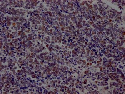 IHC image of LIG1 Recombinant Monoclonal Antibody diluted at 1:100 and staining in paraffin-embedded human lung cancer performed on a Leica BondTM system. After dewaxing and hydration, antigen retrieval was mediated by high pressure in a citrate buffer (pH 6.0). Section was blocked with 10% normal goat serum 30min at RT. Then primary antibody (1% BSA) was incubated at 4℃ overnight. The primary is detected by a Goat anti-rabbit IgG polymer labeled by HRP and visualized using 0.05% DAB.LIG1 Recombinant Monoclonal Antibody