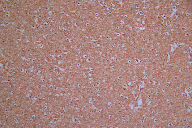 IHC image of the antibody diluted at 1:30 and staining in paraffin-embedded human brain tissue performed on a Leica BondTM system. After dewaxing and hydration, antigen retrieval was mediated by high pressure in a citrate buffer (pH 6.0). Section was blocked with 10% normal goat serum 30min at RT. Then primary antibody (1% BSA) was incubated at 4°C overnight. The primary is detected by a Goat anti-Mouse IgG labeled by HRP and visualized using 0.05% DAB.ROBO1 Recombinant Monoclonal Antibody