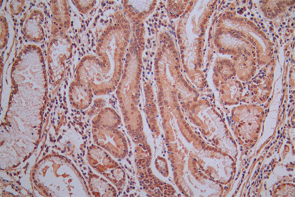 IHC image of ROBO1 Recombinant Monoclonal Antibody diluted at 1:30 and staining in paraffin-embedded human gastric cancer performed on a Leica BondTM system. After dewaxing and hydration, antigen retrieval was mediated by high pressure in a citrate buffer (pH 6.0). Section was blocked with 10% normal goat serum 30min at RT. Then primary antibody (1% BSA) was incubated at 4°C overnight. The primary is detected by a Goat anti-Mouse IgG labeled by HRP and visualized using 0.05% DAB.ROBO1 Recombinant Monoclonal Antibody