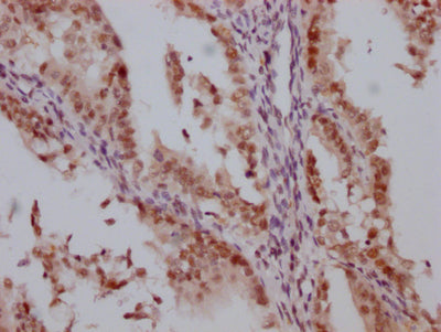 IHC image of HDAC3 Recombinant Monoclonal Antibody diluted at 1:100 and staining in paraffin-embedded human endometrial cancer performed on a Leica BondTM system. After dewaxing and hydration, antigen retrieval was mediated by high pressure in a citrate buffer (pH 6.0). Section was blocked with 10% normal goat serum 30min at RT. Then primary antibody (1% BSA) was incubated at 4℃ overnight. The primary is detected by a Goat anti-rabbit IgG polymer labeled by HRP and visualized using 0.05% DAB.HDAC3 Recombinant Monoclonal Antibody