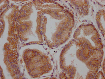 IHC image of LOXL2 Recombinant Monoclonal Antibody diluted at 1:100 and staining in paraffin-embedded human prostate tissue performed on a Leica BondTM system. After dewaxing and hydration, antigen retrieval was mediated by high pressure in a citrate buffer (pH 6.0). Section was blocked with 10% normal goat serum 30min at RT. Then primary antibody (1% BSA) was incubated at 4℃ overnight. The primary is detected by a Goat anti-rabbit IgG polymer labeled by HRP and visualized using 0.05% DAB.LOXL2 Recombinant Monoclonal Antibody