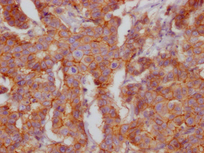 IHC image of CD46 Recombinant Monoclonal Antibody diluted at 1:100 and staining in paraffin-embedded human breast cancer performed on a Leica BondTM system. After dewaxing and hydration, antigen retrieval was mediated by high pressure in a citrate buffer (pH 6.0). Section was blocked with 10% normal goat serum 30min at RT. Then primary antibody (1% BSA) was incubated at 4℃ overnight. The primary is detected by a Goat anti-rabbit IgG polymer labeled by HRP and visualized using 0.05% DAB.
