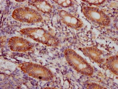 IHC image of CD46 Recombinant Monoclonal Antibody diluted at 1:100 and staining in paraffin-embedded human colon cancer performed on a Leica BondTM system. After dewaxing and hydration, antigen retrieval was mediated by high pressure in a citrate buffer (pH 6.0). Section was blocked with 10% normal goat serum 30min at RT. Then primary antibody (1% BSA) was incubated at 4℃ overnight. The primary is detected by a Goat anti-rabbit IgG polymer labeled by HRP and visualized using 0.05% DAB.