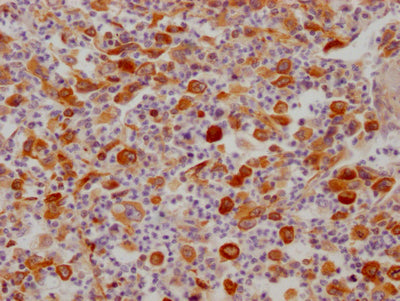 IHC image of FDFT1 Recombinant Monoclonal Antibody diluted at 1:100 and staining in paraffin-embedded human lung cancer performed on a Leica BondTM system. After dewaxing and hydration, antigen retrieval was mediated by high pressure in a citrate buffer (pH 6.0). Section was blocked with 10% normal goat serum 30min at RT. Then primary antibody (1% BSA) was incubated at 4℃ overnight. The primary is detected by a Goat anti-rabbit IgG polymer labeled by HRP and visualized using 0.05% DAB.FDFT1 Recombinant Monoclonal Antibody