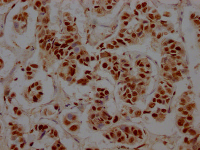 IHC image of RBBP4 Recombinant Monoclonal Antibody diluted at 1:100 and staining in paraffin-embedded human breast cancer performed on a Leica BondTM system. After dewaxing and hydration, antigen retrieval was mediated by high pressure in a citrate buffer (pH 6.0). Section was blocked with 10% normal goat serum 30min at RT. Then primary antibody (1% BSA) was incubated at 4℃ overnight. The primary is detected by a Goat anti-rabbit IgG polymer labeled by HRP and visualized using 0.05% DAB.RBBP4 Recombinant Monoclonal Antibody