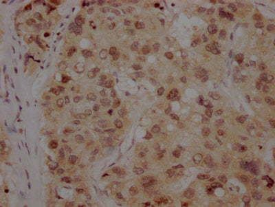 IHC image of BMI1 Recombinant Monoclonal Antibody diluted at 1:100 and staining in paraffin-embedded human liver cancer performed on a Leica BondTM system. After dewaxing and hydration, antigen retrieval was mediated by high pressure in a citrate buffer (pH 6.0). Section was blocked with 10% normal goat serum 30min at RT. Then primary antibody (1% BSA) was incubated at 4℃ overnight. The primary is detected by a Goat anti-rabbit IgG polymer labeled by HRP and visualized using 0.05% DAB.