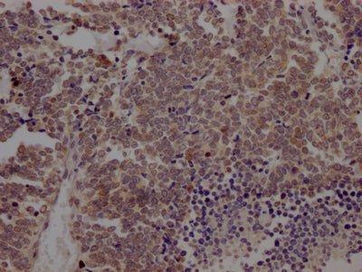 IHC image of BMI1 Recombinant Monoclonal Antibody diluted at 1:100 and staining in paraffin-embedded human lung cancer performed on a Leica BondTM system. After dewaxing and hydration, antigen retrieval was mediated by high pressure in a citrate buffer (pH 6.0). Section was blocked with 10% normal goat serum 30min at RT. Then primary antibody (1% BSA) was incubated at 4℃ overnight. The primary is detected by a Goat anti-rabbit IgG polymer labeled by HRP and visualized using 0.05% DAB.