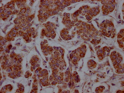 IHC image of SLC16A1 Recombinant Monoclonal Antibody diluted at 1:100 and staining in paraffin-embedded human breast cancer performed on a Leica BondTM system. After dewaxing and hydration, antigen retrieval was mediated by high pressure in a citrate buffer (pH 6.0). Section was blocked with 10% normal goat serum 30min at RT. Then primary antibody (1% BSA) was incubated at 4℃ overnight. The primary is detected by a Goat anti-rabbit IgG polymer labeled by HRP and visualized using 0.05% DAB.SLC16A1 Recombinant Monoclonal Antibody