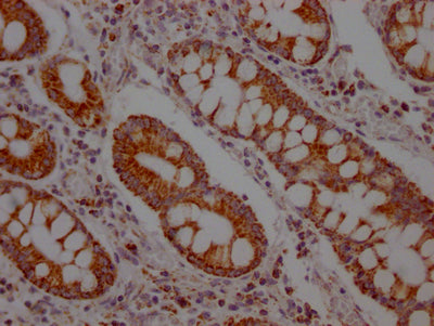 IHC image of SLC16A1 Recombinant Monoclonal Antibody diluted at 1:100 and staining in paraffin-embedded human colon cancer performed on a Leica BondTM system. After dewaxing and hydration, antigen retrieval was mediated by high pressure in a citrate buffer (pH 6.0). Section was blocked with 10% normal goat serum 30min at RT. Then primary antibody (1% BSA) was incubated at 4℃ overnight. The primary is detected by a Goat anti-rabbit IgG polymer labeled by HRP and visualized using 0.05% DAB.SLC16A1 Recombinant Monoclonal Antibody