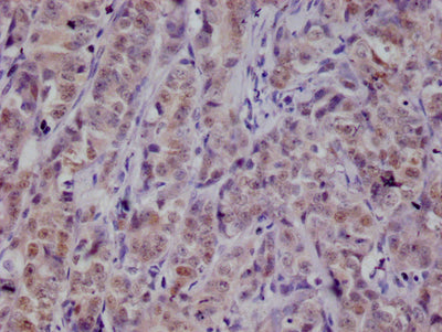 IHC image of PKN2 Recombinant Monoclonal Antibody diluted at 1:100 and staining in paraffin-embedded human colon cancer performed on a Leica BondTM system. After dewaxing and hydration, antigen retrieval was mediated by high pressure in a citrate buffer (pH 6.0). Section was blocked with 10% normal goat serum 30min at RT. Then primary antibody (1% BSA) was incubated at 4°C overnight. The primary is detected by a Goat anti-rabbit polymer IgG labeled by HRP and visualized using 0.05% DAB.PKN2 Recombinant Monoclonal Antibody
