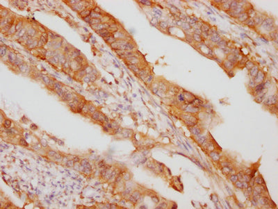 IHC image of EIF5A Recombinant Monoclonal Antibody diluted at 1:100 and staining in paraffin-embedded human colon cancer performed on a Leica BondTM system. After dewaxing and hydration, antigen retrieval was mediated by high pressure in a citrate buffer (pH 6.0). Section was blocked with 10% normal goat serum 30min at RT. Then primary antibody (1% BSA) was incubated at 4℃ overnight. The primary is detected by a Goat anti-rabbit IgG polymer labeled by HRP and visualized using 0.05% DAB.