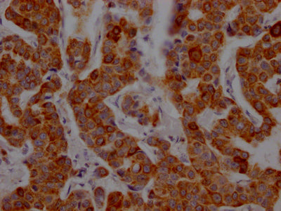 IHC image of CD8A Recombinant Monoclonal Antibody diluted at 1:100 and staining in paraffin-embedded human breast cancer performed on a Leica BondTM system. After dewaxing and hydration, antigen retrieval was mediated by high pressure in a citrate buffer (pH 6.0). Section was blocked with 10% normal goat serum 30min at RT. Then primary antibody (1% BSA) was incubated at 4℃ overnight. The primary is detected by a Goat anti-rabbit IgG polymer labeled by HRP and visualized using 0.05% DAB.