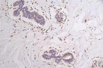 IHC image of FLT1 Recombinant Monoclonal Antibody diluted at 1:100 and staining in paraffin-embedded human breast cancer performed on a Leica BondTM system. After dewaxing and hydration, antigen retrieval was mediated by high pressure in a citrate buffer (pH 6.0). Section was blocked with 10% normal goat serum 30min at RT. Then primary antibody (1% BSA) was incubated at 4°C overnight. The primary is detected by a Goat anti-rabbit polymer IgG labeled by HRP and visualized using 0.21% DAB.FLT1 Recombinant Monoclonal Antibody