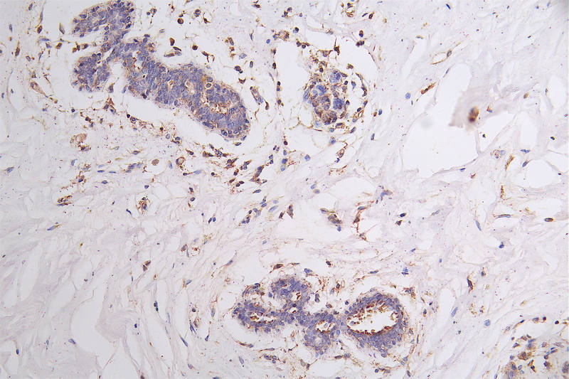 IHC image of FLT1 Recombinant Monoclonal Antibody diluted at 1:100 and staining in paraffin-embedded human breast cancer performed on a Leica BondTM system. After dewaxing and hydration, antigen retrieval was mediated by high pressure in a citrate buffer (pH 6.0). Section was blocked with 10% normal goat serum 30min at RT. Then primary antibody (1% BSA) was incubated at 4°C overnight. The primary is detected by a Goat anti-rabbit polymer IgG labeled by HRP and visualized using 0.21% DAB.FLT1 Recombinant Monoclonal Antibody