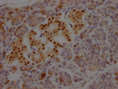 IHC image of ISL1 Recombinant Monoclonal Antibody diluted at 1:100 and staining in paraffin-embedded human pancreatic tissue performed on a Leica BondTM system. After dewaxing and hydration, antigen retrieval was mediated by high pressure in a citrate buffer (pH 6.0). Section was blocked with 10% normal goat serum 30min at RT. Then primary antibody (1% BSA) was incubated at 4℃ overnight. The primary is detected by a Goat anti-rabbit IgG polymer labeled by HRP and visualized using 0.05% DAB.ISL1 Recombinant Monoclonal Antibody