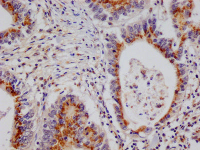 IHC image of PSME1 Recombinant Monoclonal Antibody diluted at 1:100 and staining in paraffin-embedded human colon cancer performed on a Leica BondTM system. After dewaxing and hydration, antigen retrieval was mediated by high pressure in a citrate buffer (pH 6.0). Section was blocked with 10% normal goat serum 30min at RT. Then primary antibody (1% BSA) was incubated at 4°C overnight. The primary is detected by a Goat anti-rabbit polymer IgG labeled by HRP and visualized using 0.05% DAB.PSME1 Recombinant Monoclonal Antibody
