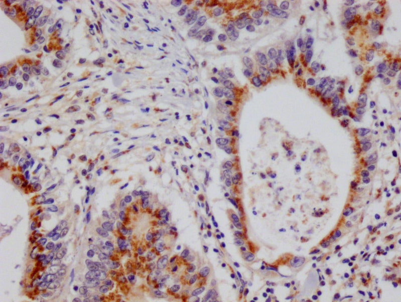 IHC image of PSME1 Recombinant Monoclonal Antibody diluted at 1:100 and staining in paraffin-embedded human colon cancer performed on a Leica BondTM system. After dewaxing and hydration, antigen retrieval was mediated by high pressure in a citrate buffer (pH 6.0). Section was blocked with 10% normal goat serum 30min at RT. Then primary antibody (1% BSA) was incubated at 4°C overnight. The primary is detected by a Goat anti-rabbit polymer IgG labeled by HRP and visualized using 0.05% DAB.PSME1 Recombinant Monoclonal Antibody