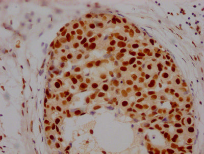 IHC image of HDAC2 Recombinant Monoclonal Antibody diluted at 1:100 and staining in paraffin-embedded human breast cancer performed on a Leica BondTM system. After dewaxing and hydration, antigen retrieval was mediated by high pressure in a citrate buffer (pH 6.0). Section was blocked with 10% normal goat serum 30min at RT. Then primary antibody (1% BSA) was incubated at 4℃ overnight. The primary is detected by a Goat anti-rabbit IgG polymer labeled by HRP and visualized using 0.05% DAB.HDAC2 Recombinant Monoclonal Antibody