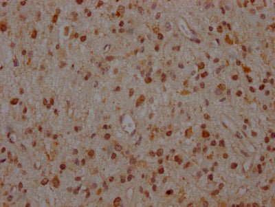 IHC image of MAP2K1 Recombinant Monoclonal Antibody diluted at 1:100 and staining in paraffin-embedded human glioma cancer performed on a Leica BondTM system. After dewaxing and hydration, antigen retrieval was mediated by high pressure in a citrate buffer (pH 6.0). Section was blocked with 10% normal goat serum 30min at RT. Then primary antibody (1% BSA) was incubated at 4℃ overnight. The primary is detected by a Goat anti-rabbit IgG polymer labeled by HRP and visualized using 0.05% DAB.MAP2K1 Recombinant Monoclonal Antibody