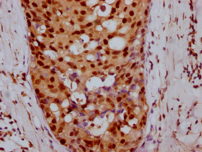IHC image of the antibody diluted at 1:100 and staining in paraffin-embedded human breast cancer performed on a Leica BondTM system. After dewaxing and hydration, antigen retrieval was mediated by high pressure in a citrate buffer (pH 6.0). Section was blocked with 10% normal goat serum 30min at RT. Then primary antibody (1% BSA) was incubated at 4℃ overnight. The primary is detected by a Goat anti-rabbit IgG polymer labeled by HRP and visualized using 0.05% DAB.
