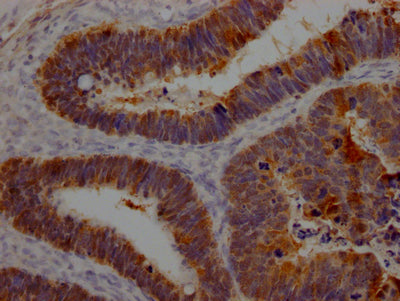 IHC image of LGALS3 Recombinant Monoclonal Antibody diluted at 1:100 and staining in paraffin-embedded human ovarian cancer performed on a Leica BondTM system. After dewaxing and hydration, antigen retrieval was mediated by high pressure in a citrate buffer (pH 6.0). Section was blocked with 10% normal goat serum 30min at RT. Then primary antibody (1% BSA) was incubated at 4℃ overnight. The primary is detected by a Goat anti-rabbit IgG polymer labeled by HRP and visualized using 0.05% DAB.LGALS3 Recombinant Monoclonal Antibody