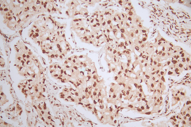 IHC image of Phospho-MDM2 (S166) Recombinant Monoclonal Antibody diluted at 1:50 and staining in paraffin-embedded human lung cancer performed on a Leica BondTM system. After dewaxing and hydration, antigen retrieval was mediated by high pressure in a citrate buffer (pH 6.0). Section was blocked with 10% normal goat serum 30min at RT. Then primary antibody (1% BSA) was incubated at 4°C overnight. The primary is detected by a Goat anti-rabbit polymer IgG labeled by HRP and visualized using 0.57% DAB.Phospho-MDM2 (S166) Recombinant Monoclonal Antibody
